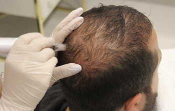 Hair transplant with lack of density enhanced using scalp micropigmentation for fuller coverage