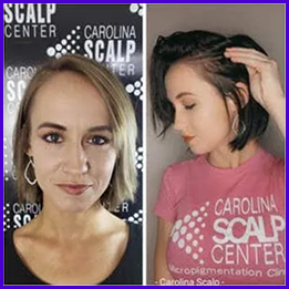 SMP for women adding density to thinning hair