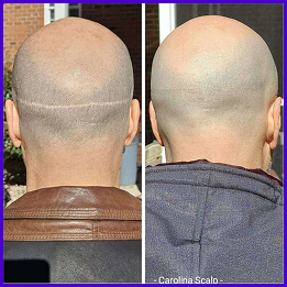 SMP for scar camouflage improving the appearance of scalp scars