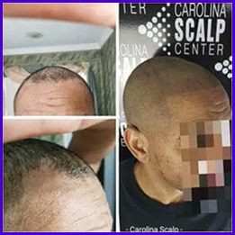 SMP treatment for alopecia to restore natural-looking coverage