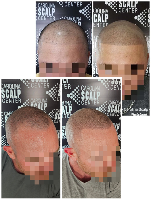 SMP for men adding density to thinning hair for a fuller appearance