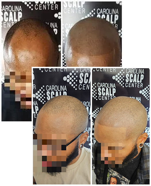 SMP for men restoring a strong, natural-looking hairline