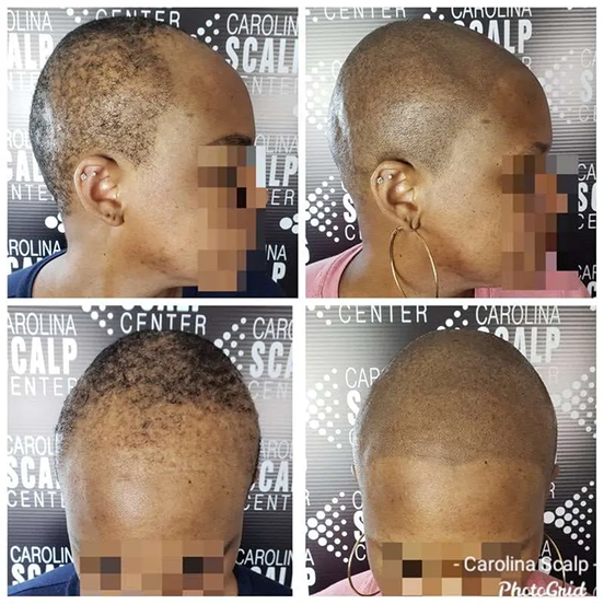 SMP for women reducing visible scalp in the part line for a fuller look