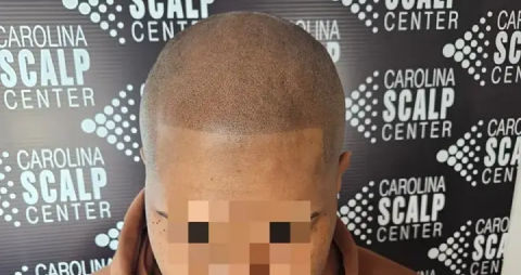 SMP for scars blending dot-like FUE transplant scars into the scalp