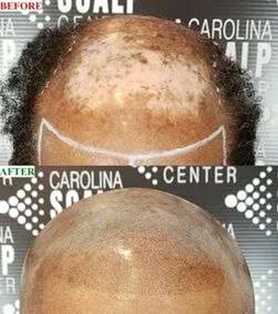 SMP for scars camouflaging FUE and FUT scalp scars for a smoother look