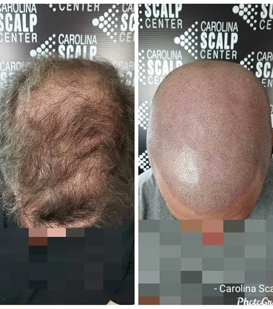 SMP for alopecia providing natural-looking scalp coverage